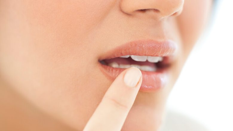 Munsår: Triggers, symtom och behandlingar för herpes simplex-virus