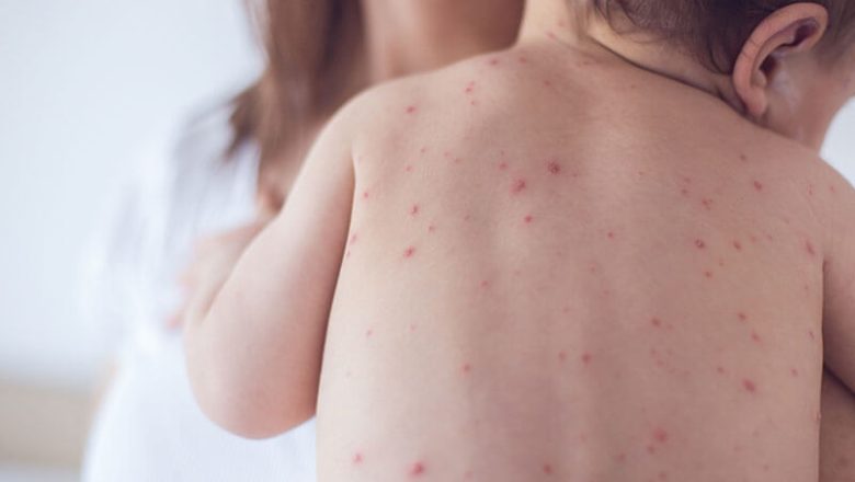 Mässlingsutbrott: Vad du behöver veta |  Friskvårdens hus